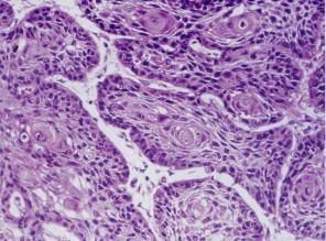 A B Hình 1 1 Vi thể ung thư biểu mô phổi Hình ảnh vi thể ung thư biểu mô phổi 2