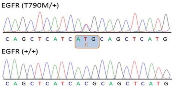 Hình 1 4 Kết quả giải trình tự gen xác định đột biến EGFR T790M Ở mẫu bình 3