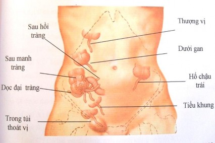 Hình 1 1 Các vị trí của ruột thừa Nguồn theo Nguyễn Quang Quyền 2001 11 Mạc treo 1
