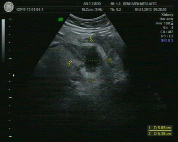 Hình 1 3 Hình ảnh áp xe ruột thừa trên siêu âm Nguồn BV Medlatec 17 Do bản chất 1