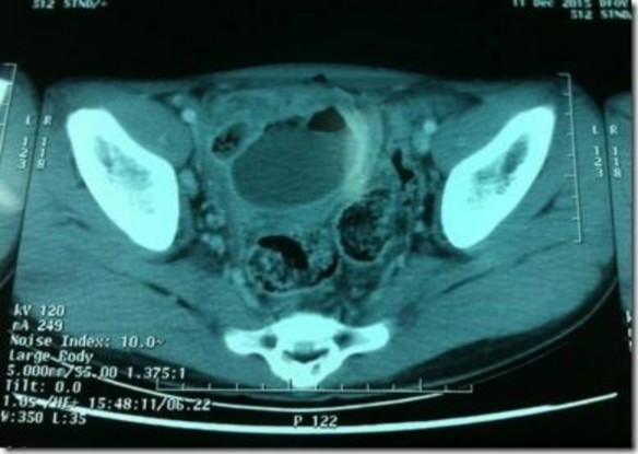 Hình 1 4 Hình ảnh áp xe ruột thừa trên CLVT Nguồn Dr Mohamed Saber 18 Fluid collection 2