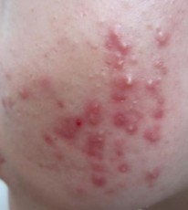 Hình 4 1 Bệnh nhân mụn trứng cá Nhận xét bệnh nhân ở mức độ nhẹ và trung 1