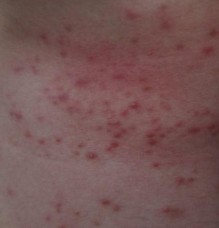 Hình 4 1 Bệnh nhân mụn trứng cá Nhận xét bệnh nhân ở mức độ nhẹ và trung 2