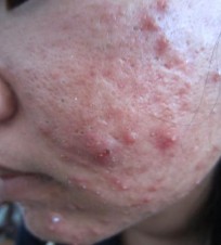 Hình 4 1 Bệnh nhân mụn trứng cá Nhận xét bệnh nhân ở mức độ nhẹ và trung 3