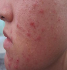 Hình 4 1 Bệnh nhân mụn trứng cá Nhận xét bệnh nhân ở mức độ nhẹ và trung 4