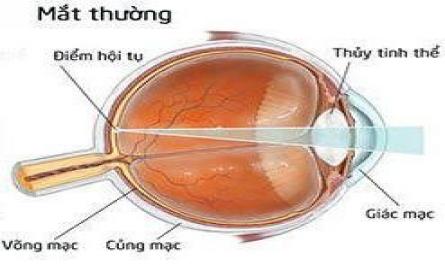 Đánh giá tình trạng cận thị ở trẻ em và việc điều chỉnh kính - 2