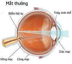 Mắt chính thị là mắt bình thường không có tật khúc xạ Khi ở trạng thái 1