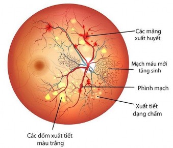 Hình 1 2 Tổn thương võng mạc đái tháo đường 18 1 3 1 Bệnh võng mạc đái tháo 2