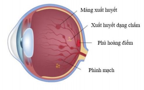 Hình 1 3 Biến chứng phù hoàng điểm đái tháo đường 19 Hiện tại phân loại 1