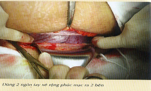 Hình 1 2 Phương pháp mổ lấy thai ngang đoạn dưới tử cung Trích từ các kỹ 1