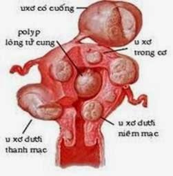 Hình 1 1 Các vị trí của u xơ tử cung 9 U xơ tử cung là khối u lành tính ở tử 1